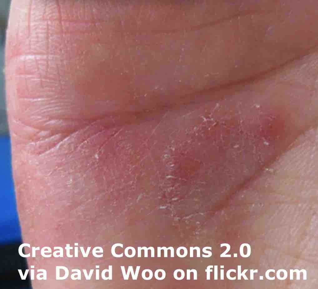 breaking-news-english-speed-reading-100-wpm-eczema-and-itchiness